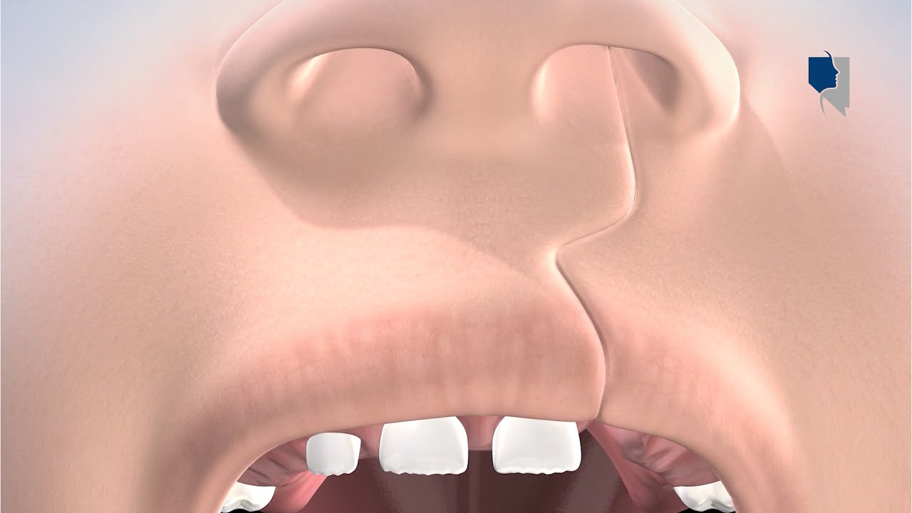 Cleft Lip & Palate Treatment at Northern Nevada Oral & Maxillofacial Surgery, Reno and Sparks, NV