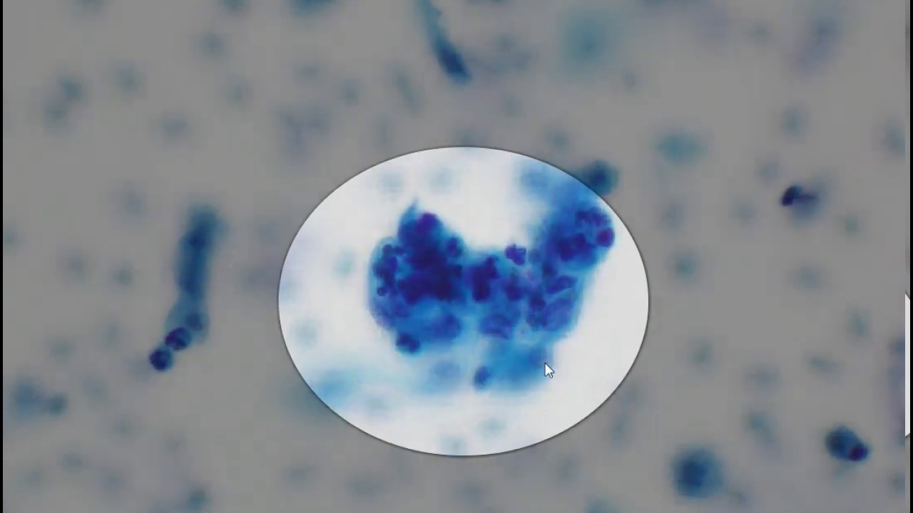 Cervical smear cytology  - AGC (Endometrial cells)