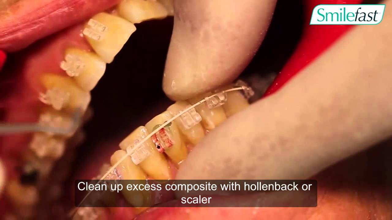 Smilefast: Bracket ReBonding