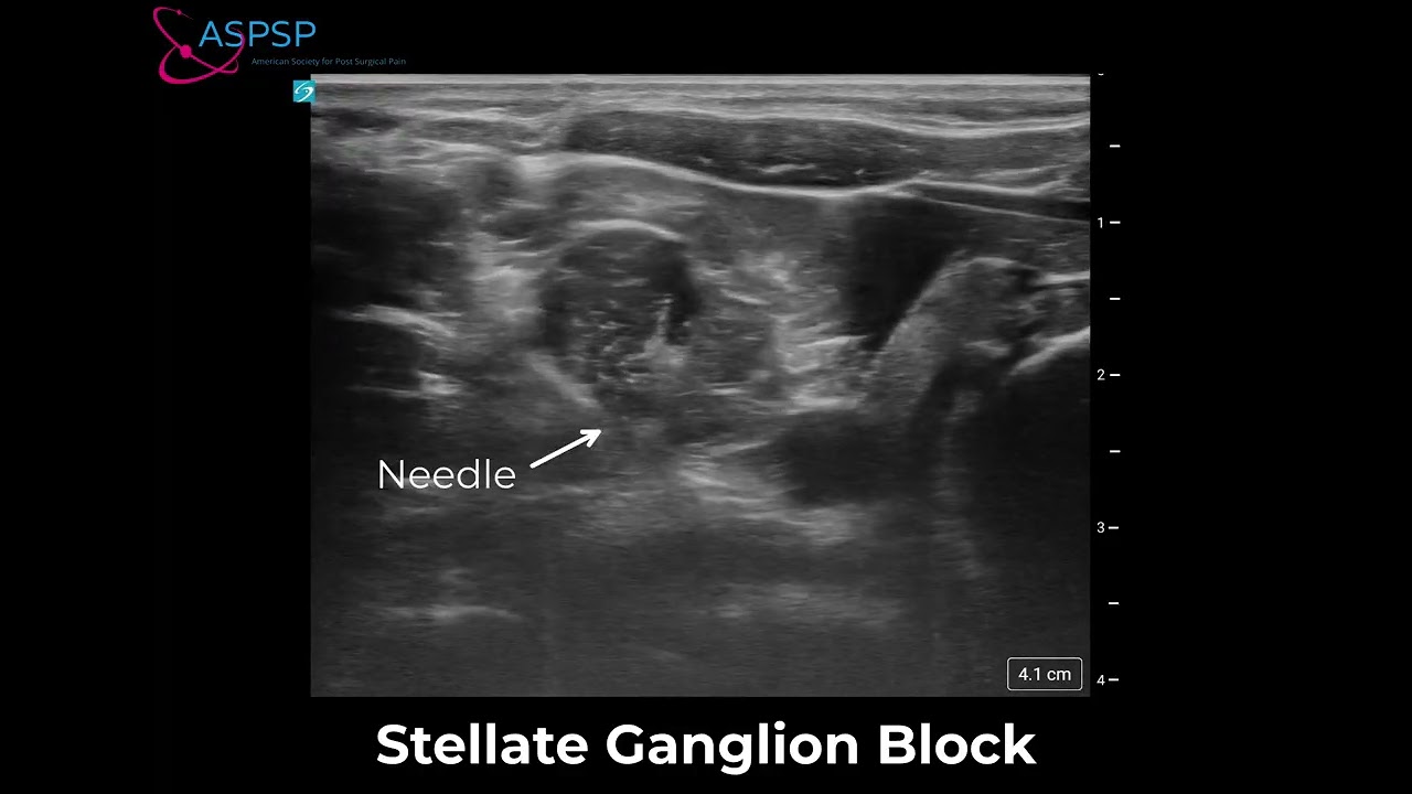 Right Stellate Ganglion Block #2