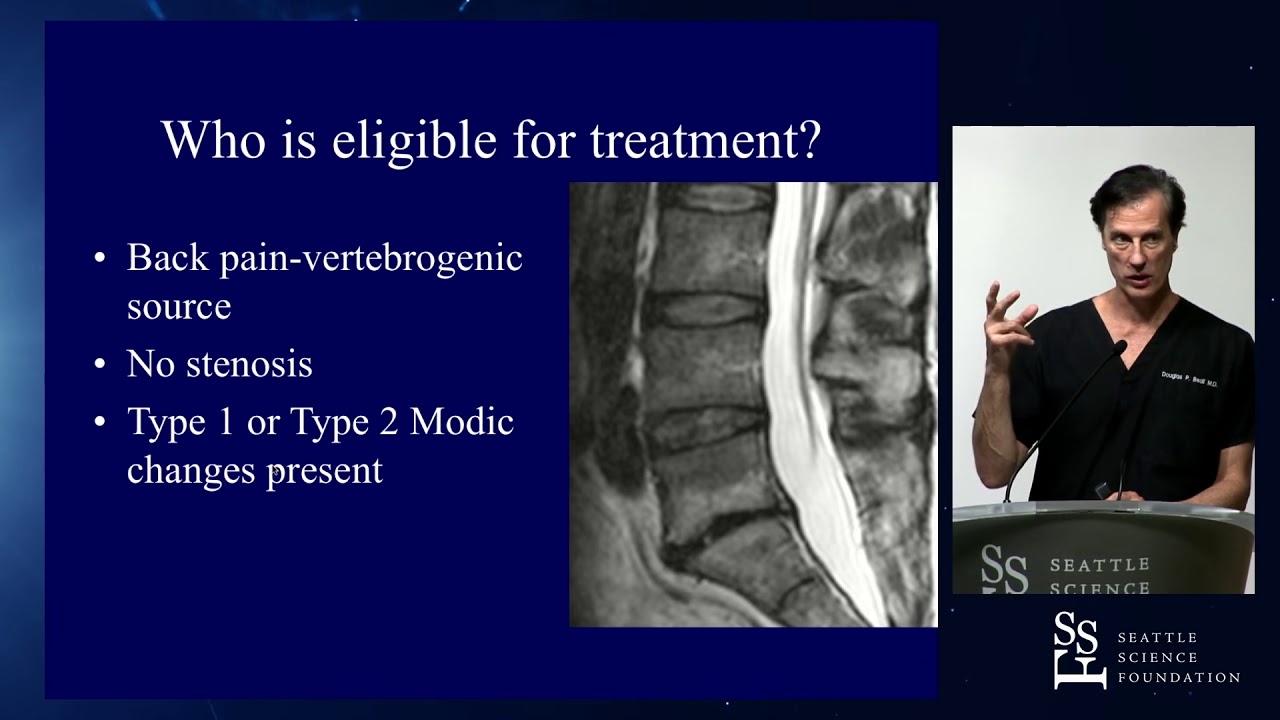Treatment of Low Back Pain with Basivertebral Nerve Ablation - Douglas P. Beall, MD