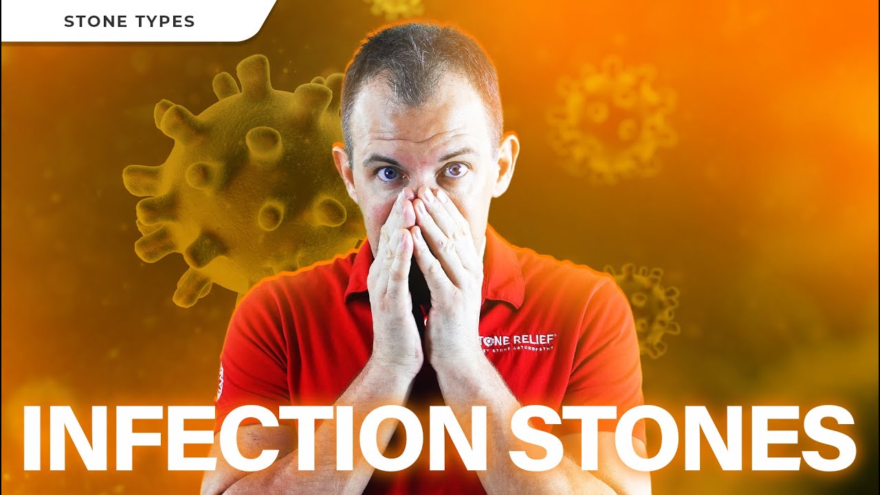 Struvite Kidney Stones Explained: Symptoms, Treatment & Prevention