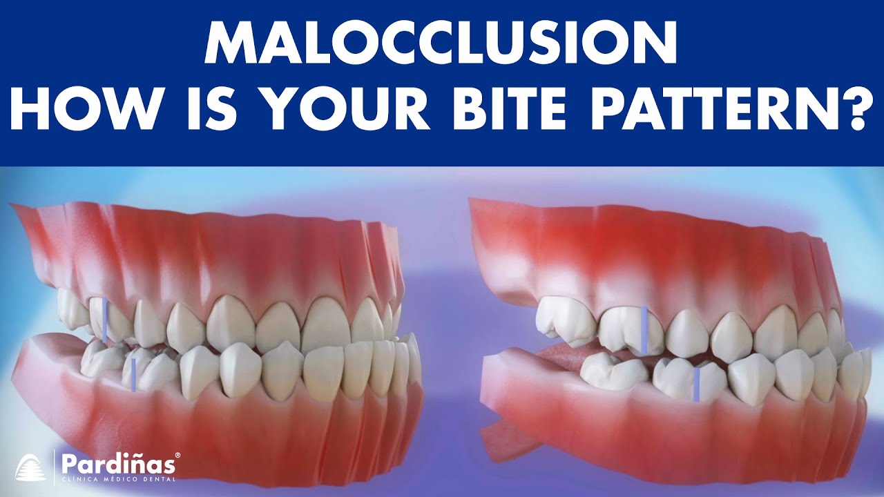 Malocclusion - Bite patterns &copy;