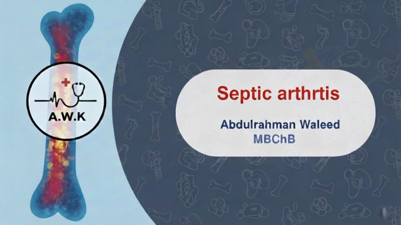 Orthopedic diseases “ Septic arthritis “ 