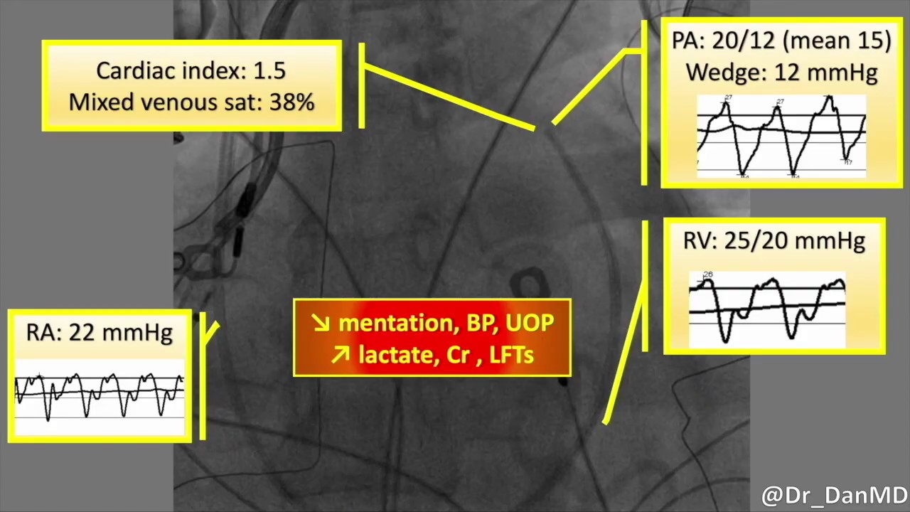 ARVC TR PAcath RPimpella