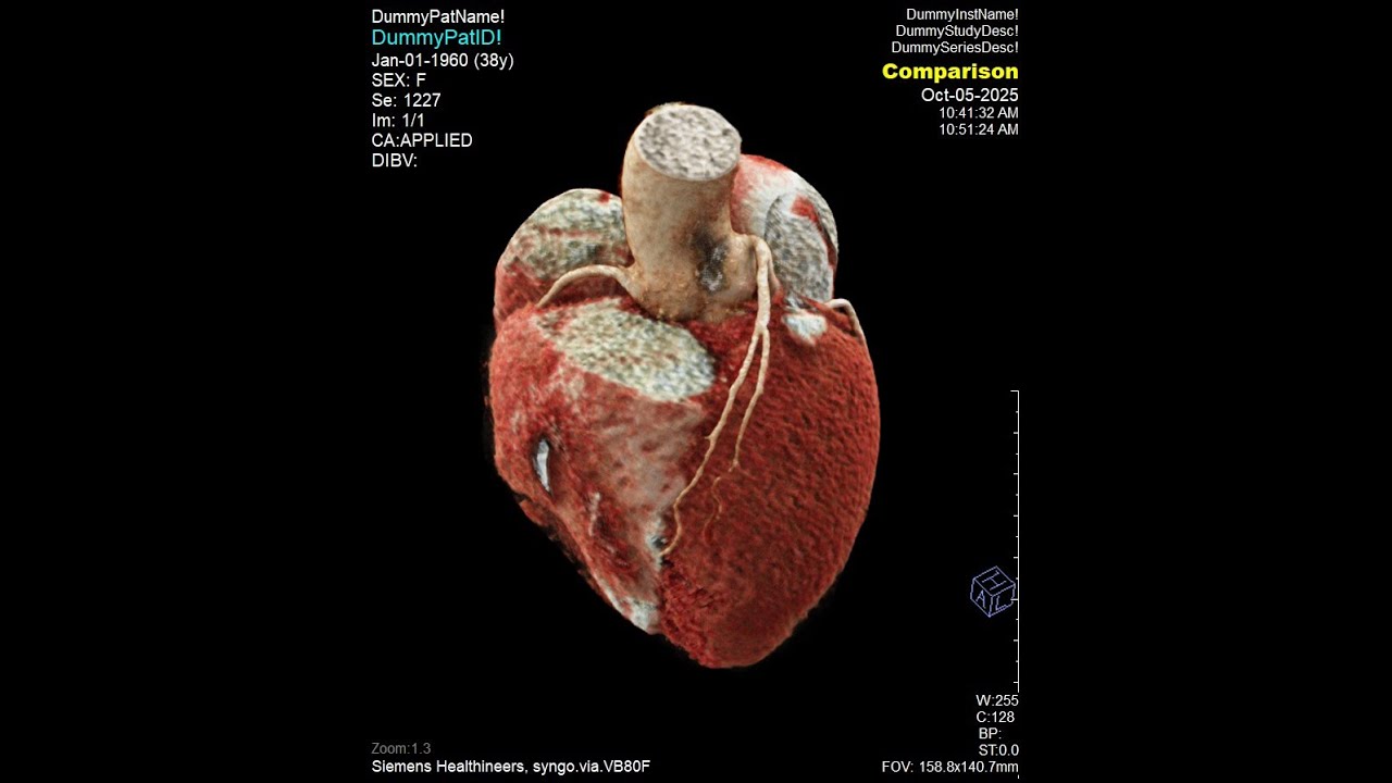 30 mL Coronay CTA, retrospective ECG gating with mA modulation , DLP 171