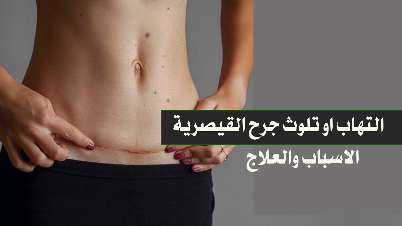 تشخيص التهاب او تلوث جرح القيصرية وعلاجة مع د / محمد بدر