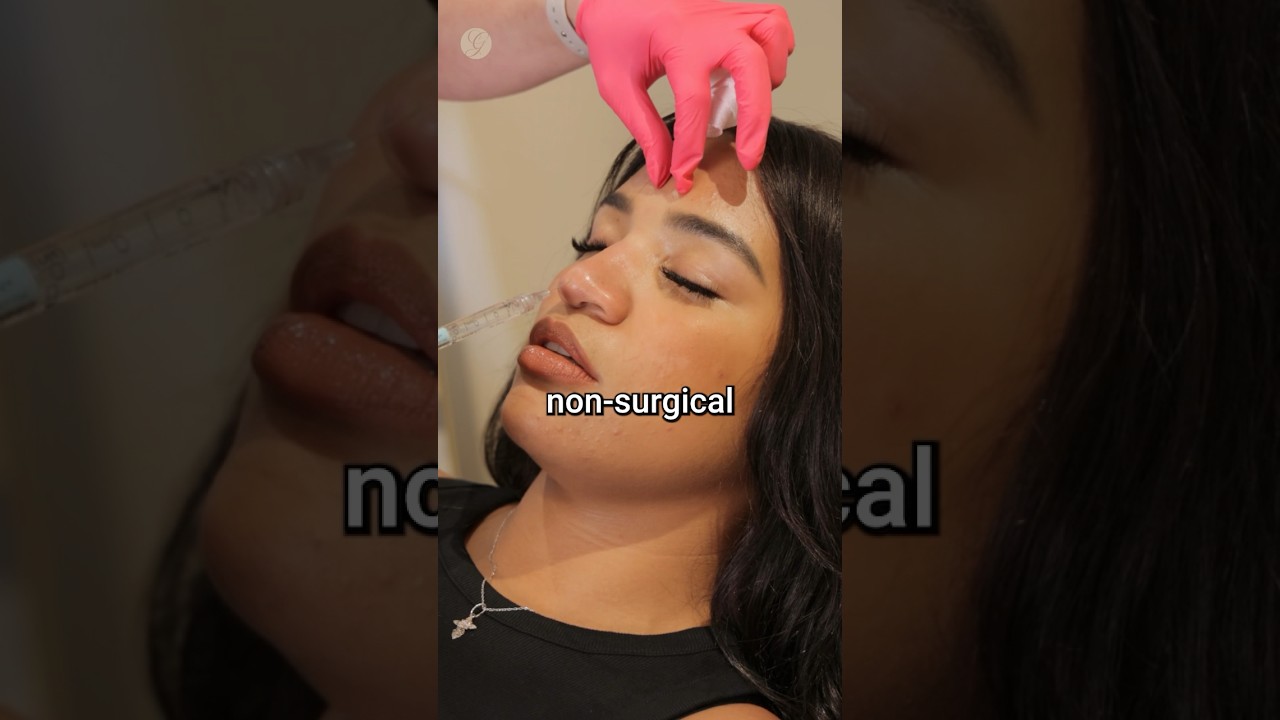 Безоперационная ринопластика #косметическаяхирургия #ринопластика #нос #нос #говирус