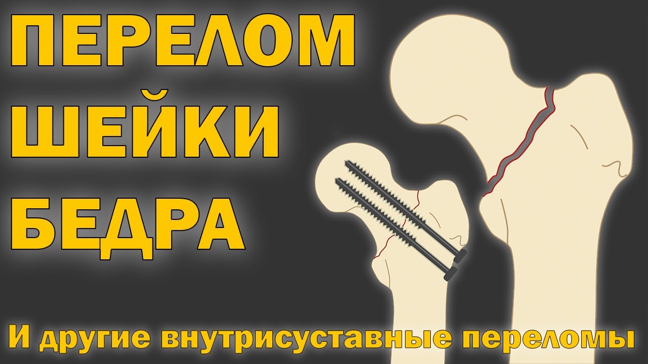 Перелом шейки бедра, мыщелковый перелом, перелом локтя, частичное протезирование [S05E16]