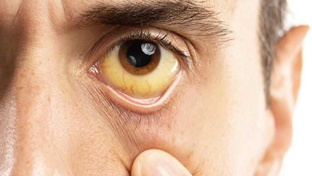 Hepatit C virusu insana BU CÜR keçir