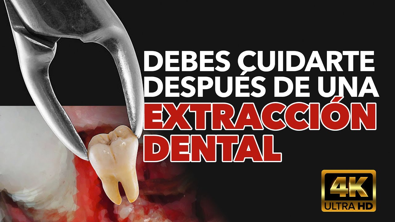Qué hacer después de una #extraccióndental 🦷 | Consejos del Dr. Alex