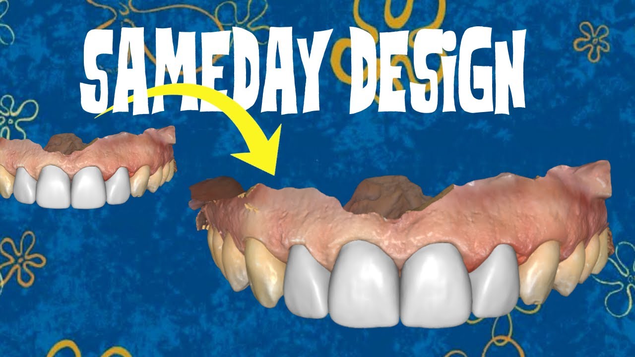 Same Day CEREC Design: Start To Finish In 30 Minutes