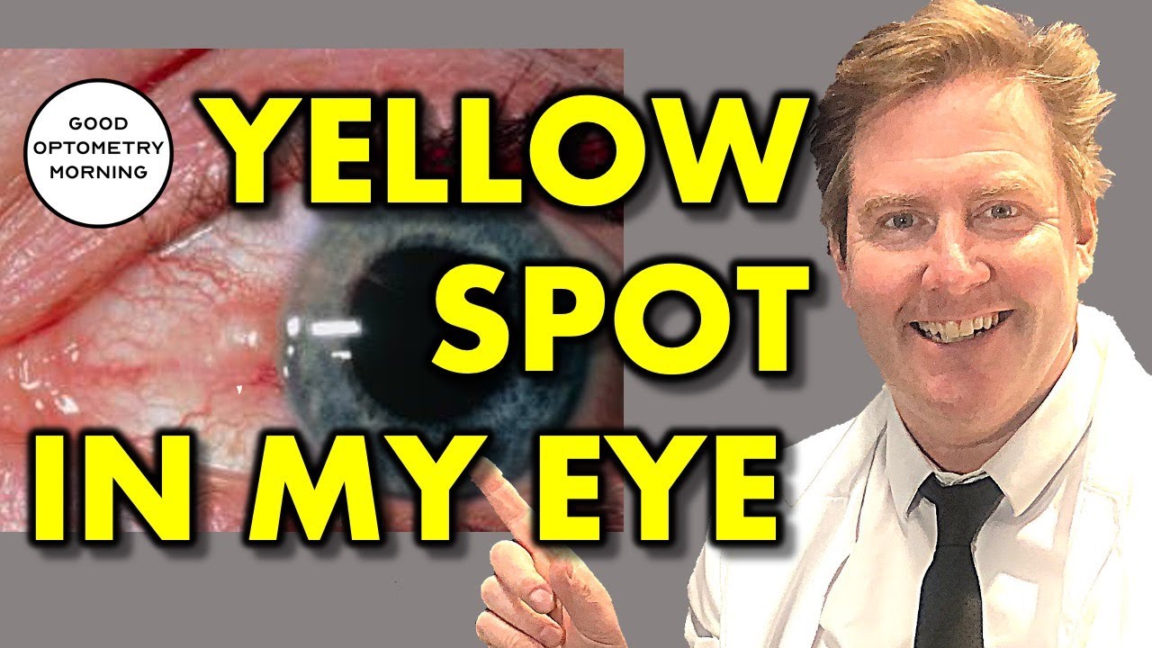 ЖЕЛТОЕ ПЯТНО В ГЛАЗУ: лечение пингвекулы от Youtube Eye Doctor & Optometrist