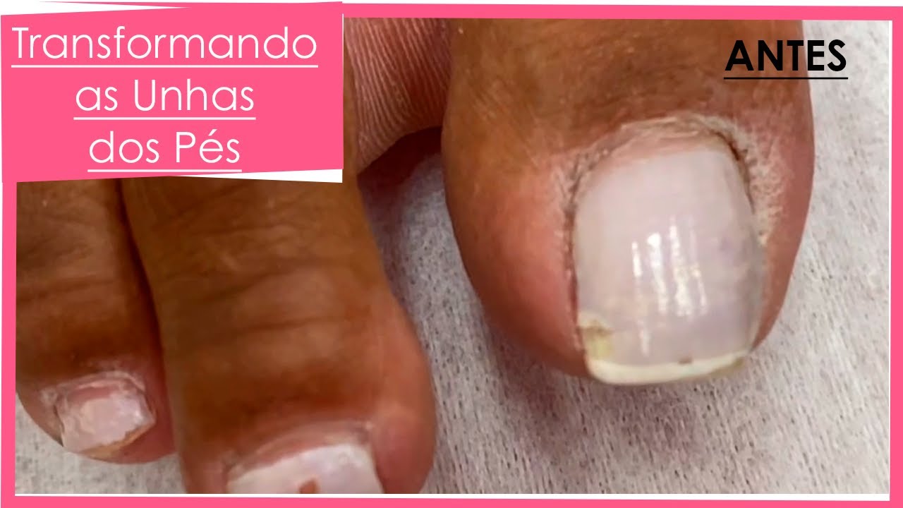 Transformação Nos Pés (Pedicure Transformação)
