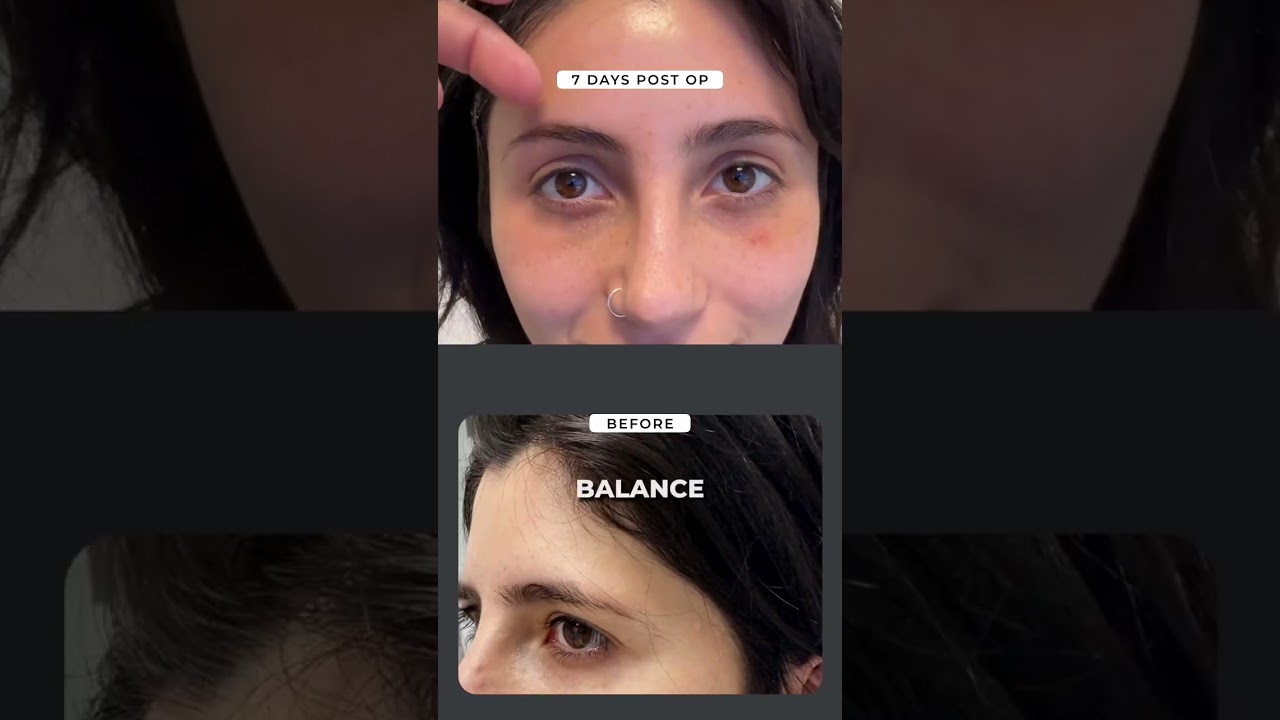 7 Days Post-Op: Endoscopic Brow Lift Update