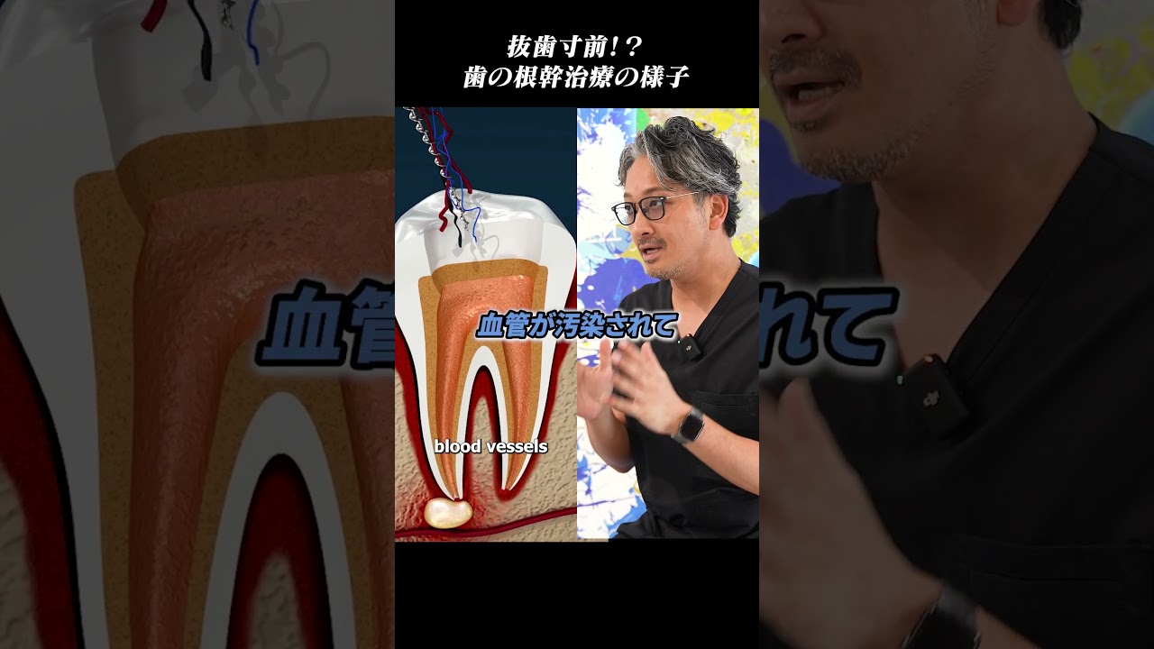 虫歯治療#shorts