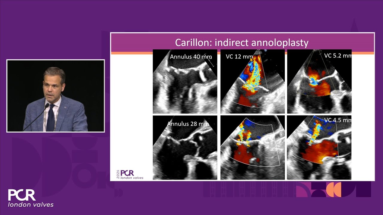 Cinch it if you can - Indirect annuloplasty for functional mitral regurgitation