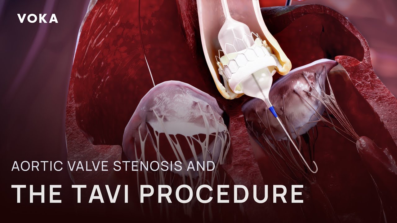 How does TAVI procedure treat aortic valve stenosis?