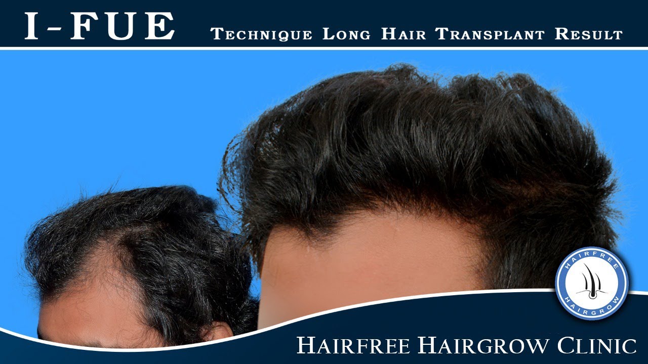 Long Hair Transplant || 💯% Natural Result with High Density || Hairfree Hairgrow Clinic Pimple Gurav