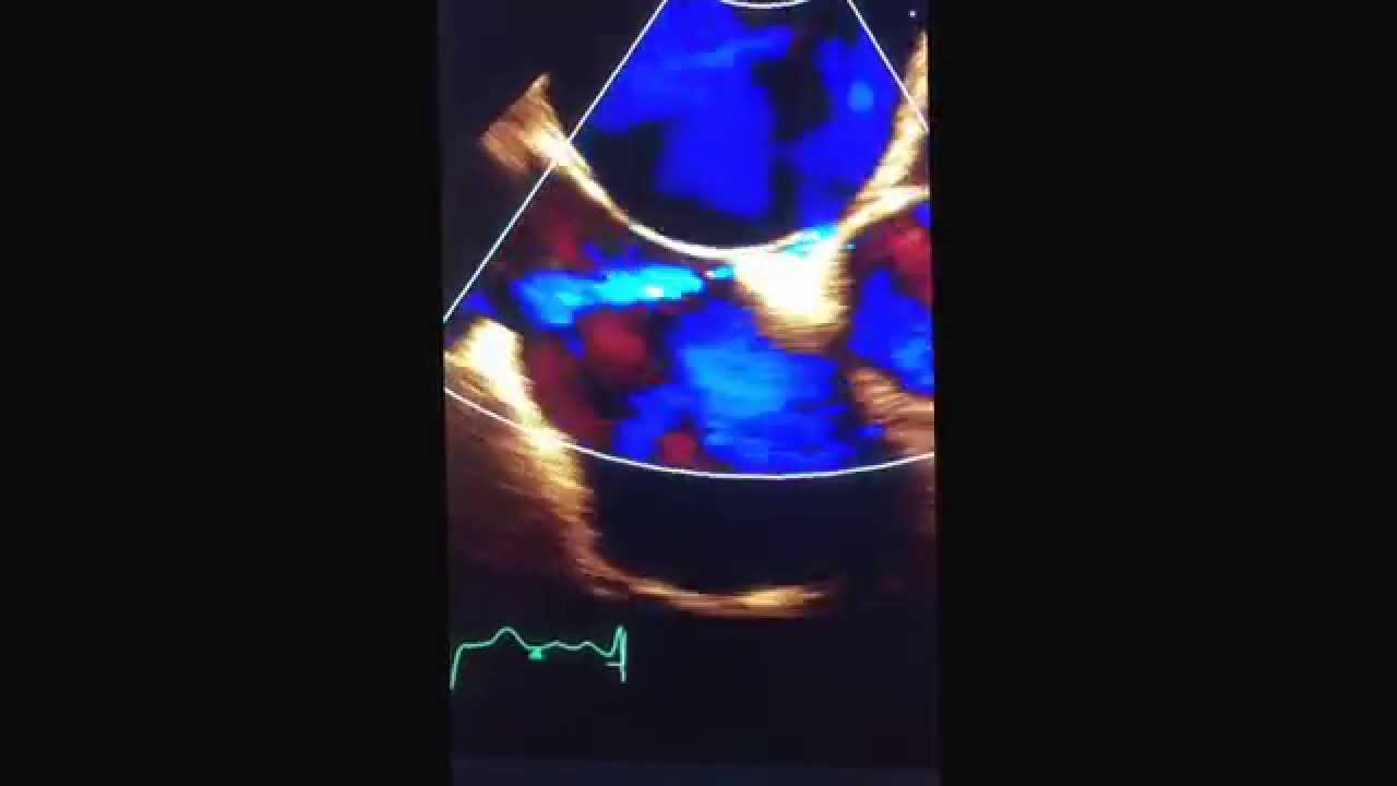 FOP chez un patient qui a présenté un AVC. Shunt Doppler couleur de gauche à droite