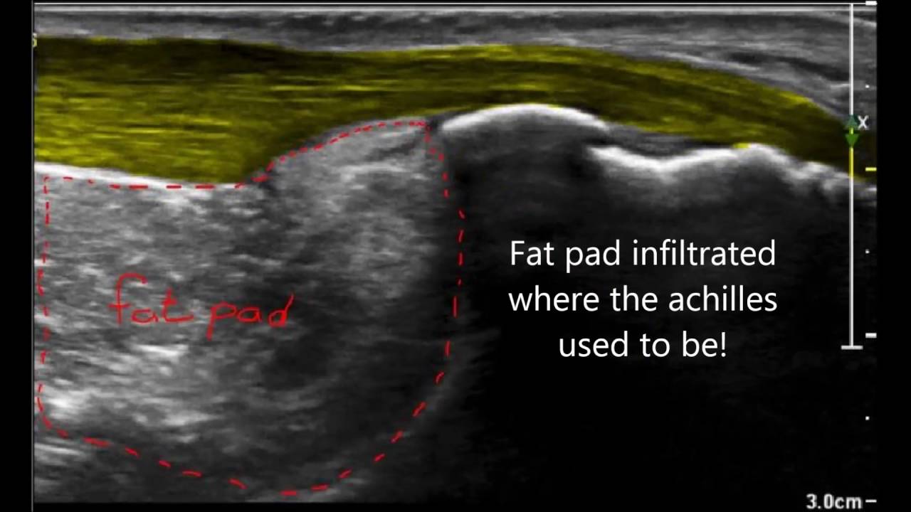 Haglund deformity versus haglund syndrome