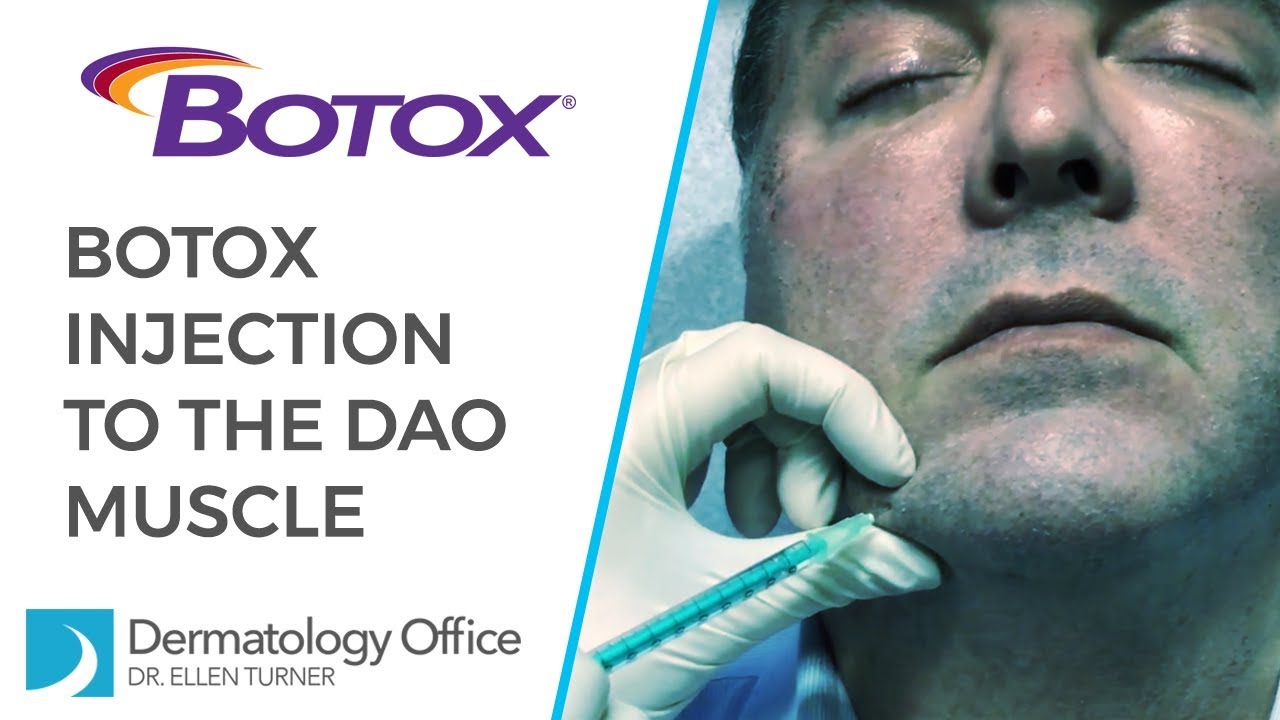 The DAO Muscle - BOTOX® Injections in Dallas
