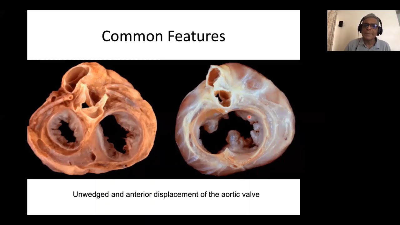 Philip Echo Webinar Series AV Septal Defect  Echo Assessment  by Dr  Krishna Kumar, Amrita Institute