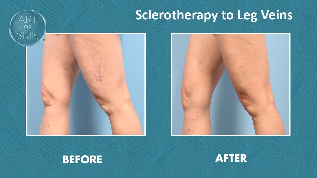 Leg vein treatment with foam sclerotherapy