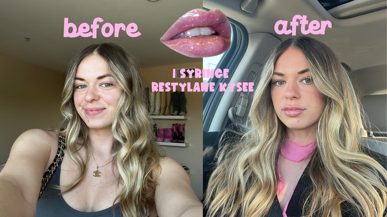 GETTING 1 SYRINGE RESTYLANE KYSEE LIP FILLER  *pain level, aftercare, 2 weeks healing*