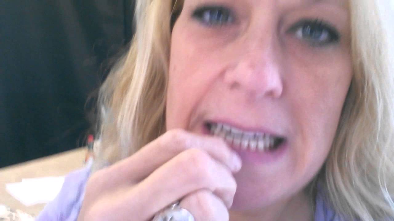 My new lower jaw implants