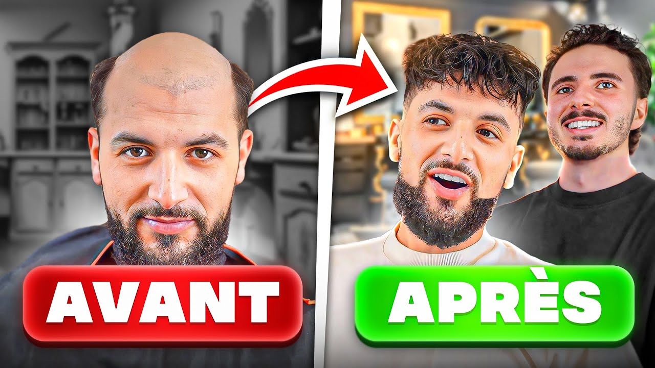 Adieu la CALVITIE ! Le COMPLEMENT CAPILLAIRE mieux que la greffe de cheveux ?