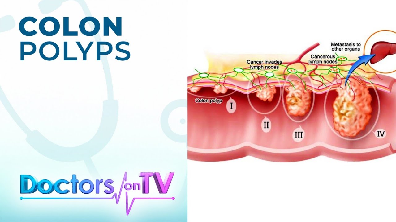 Colorectal Cancer: Warning Signs, Prevention, Treatment  | DOTV