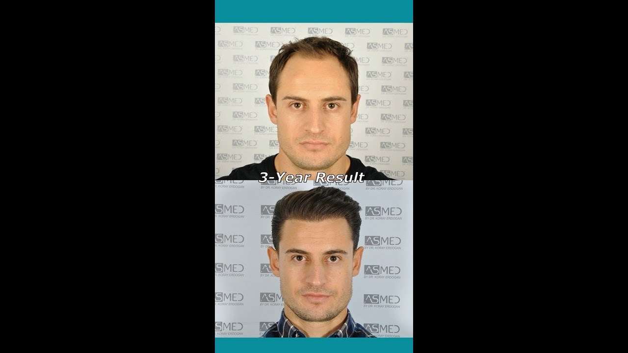 Here is the 4400 grafts result of one of our dearest patients, Florian!