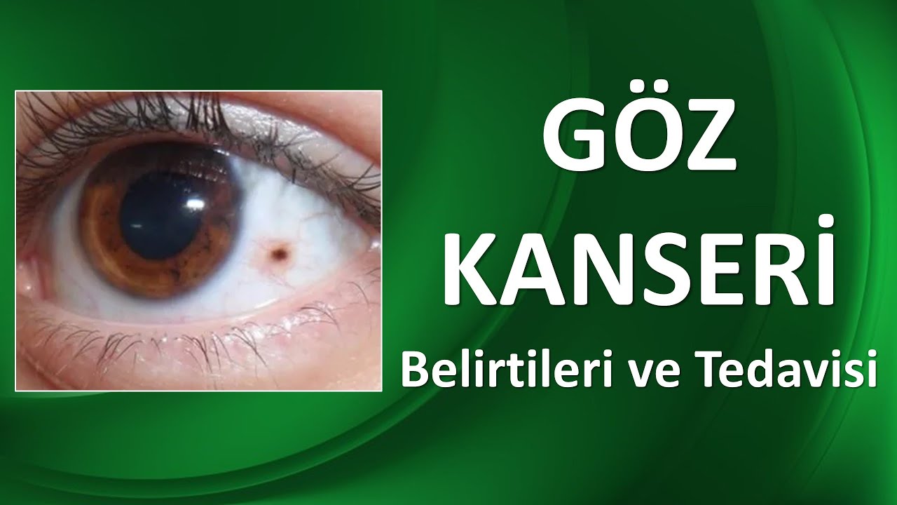 GÖZ KANSERİ NEDİR? Belirti ve Tedavi Yöntemleri Nelerdir?