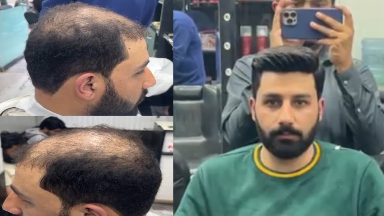 Best Hair Wig 2026 | Natural Front Hair Line Patch | Hair Patch In nRawalpindi | Falak Hair Club