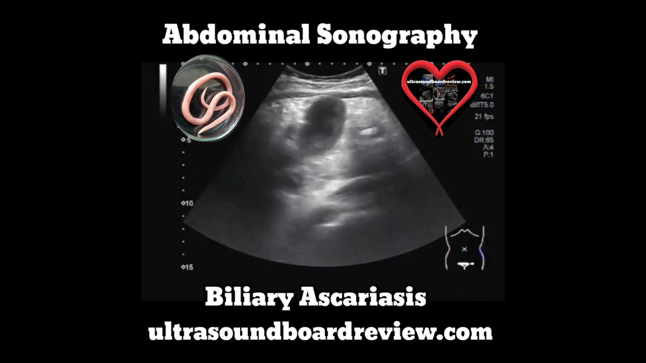 Biliary Ascariasis