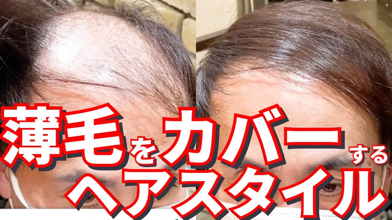 【O字+M字ハゲ】髪の長さを残してカバーする方法