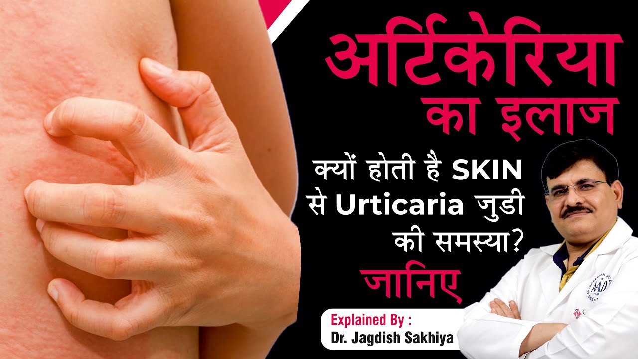 Urticaria (Hives) Causes, Symptoms & Treatment ( In Hindi ) | Dr. Jagdish Sakhiya Skin Clinic