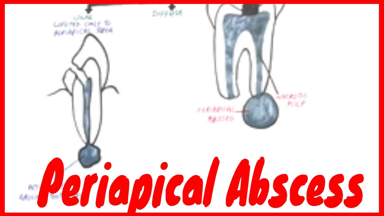 Periapical Abscess: Causes, Symptoms & Treatment
