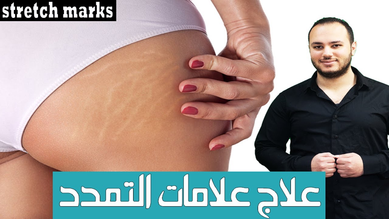 علاج علامات التمدد | Stretch Marks