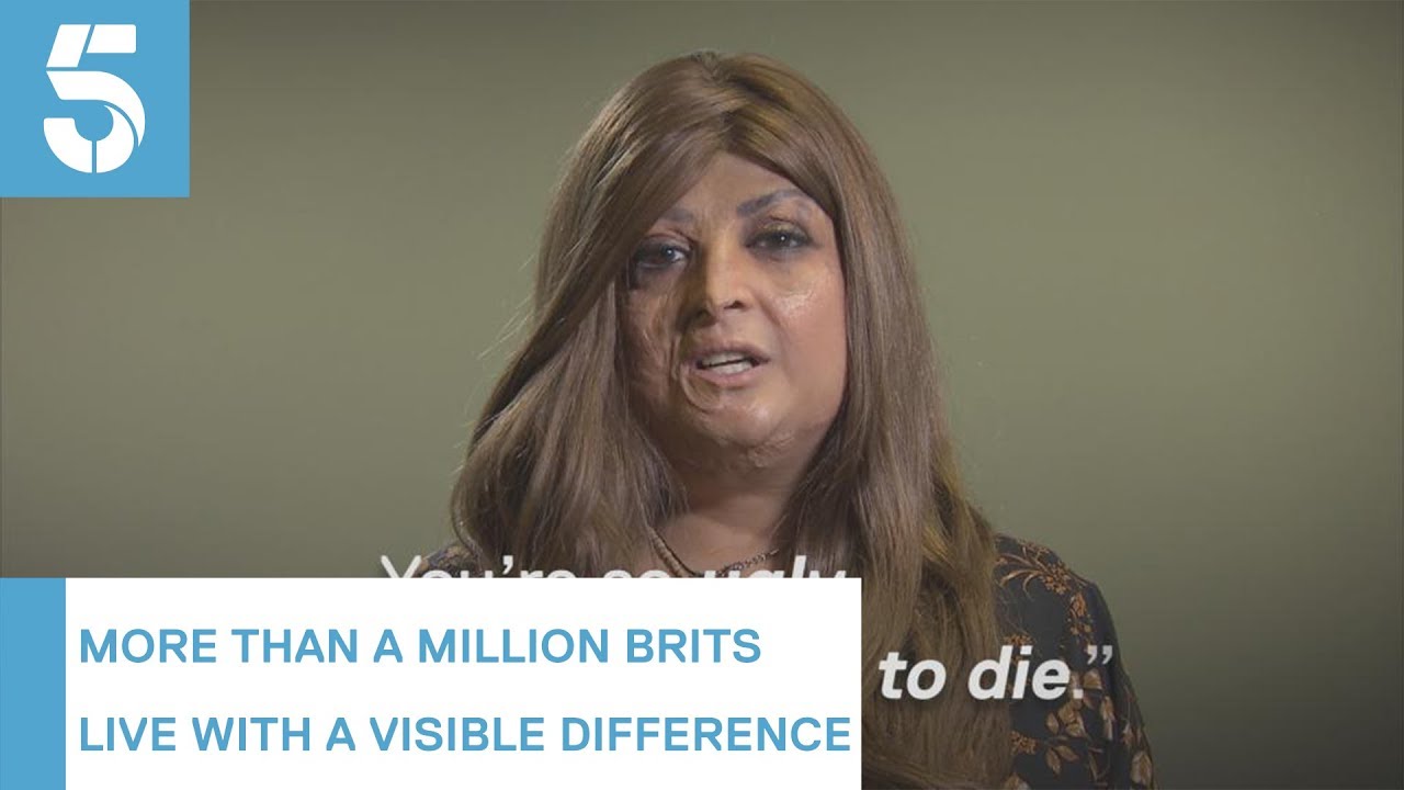 More than a quarter of people with a facial disfigurement experience hate crime | 5 News