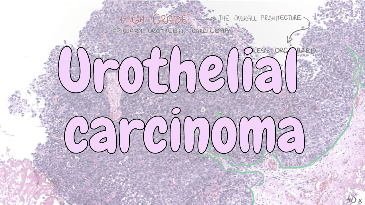 Urothelial carcinoma - urinary system pathology