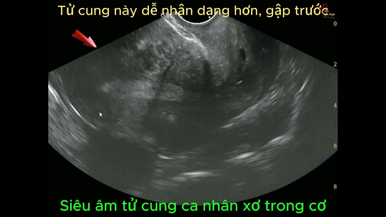 Trở Ngại Trong Siêu Âm Phụ Khoa #Siêu_âm_phụ_khoa