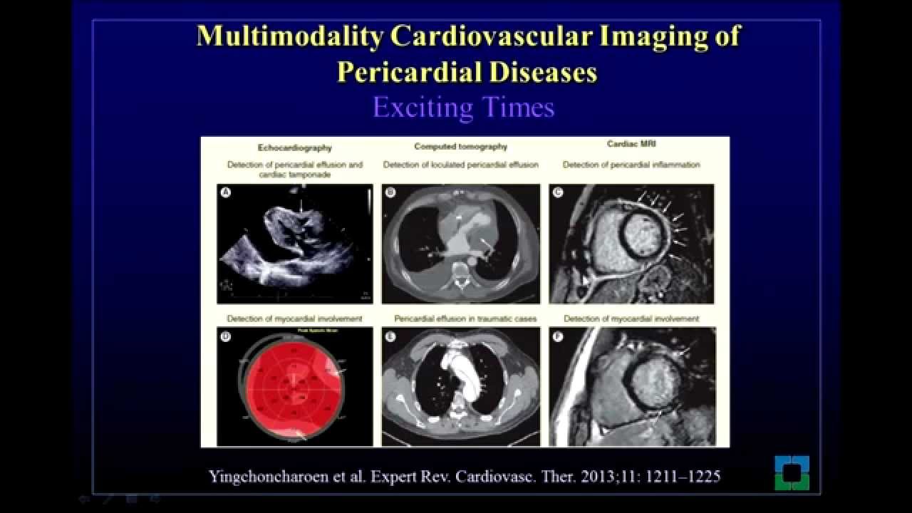 Multimodality Cardiovascular Imaging of Patients with Pericardial Disease