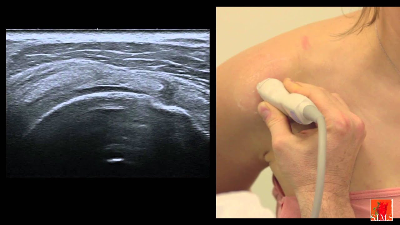 ultrasound of the shoulder II
