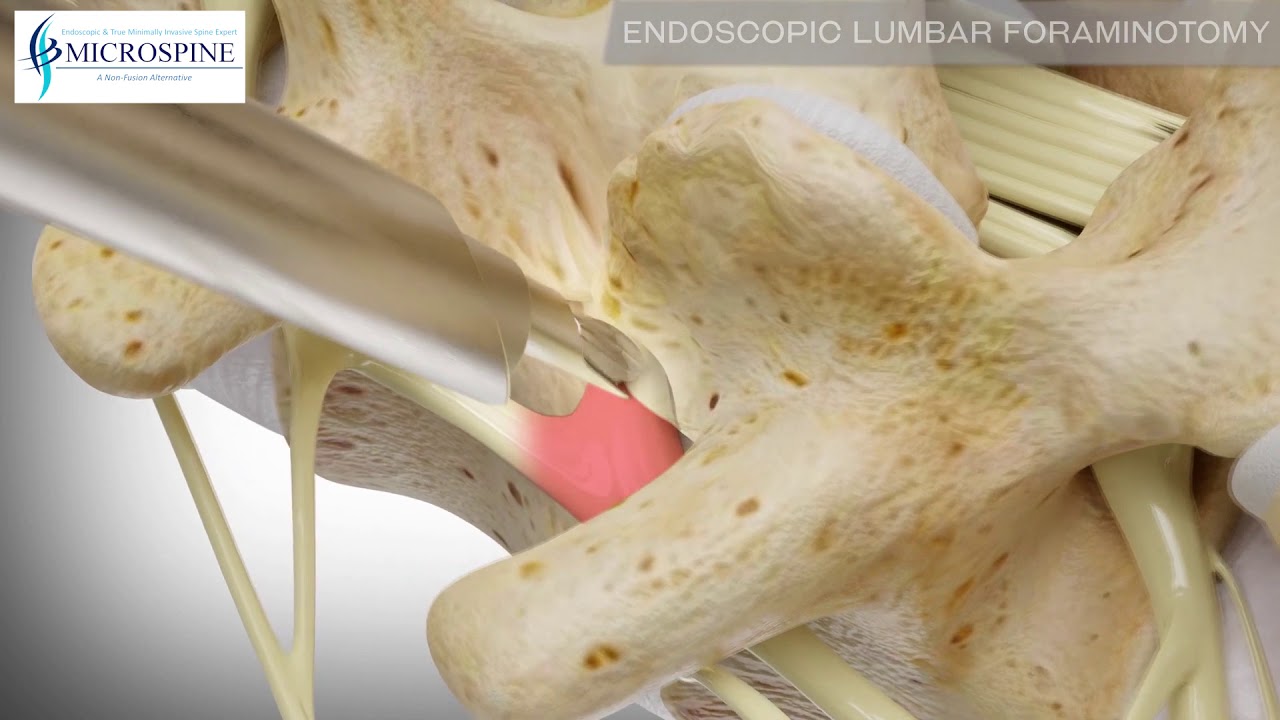 03 Endoscopic Lumbar Foraminotomy