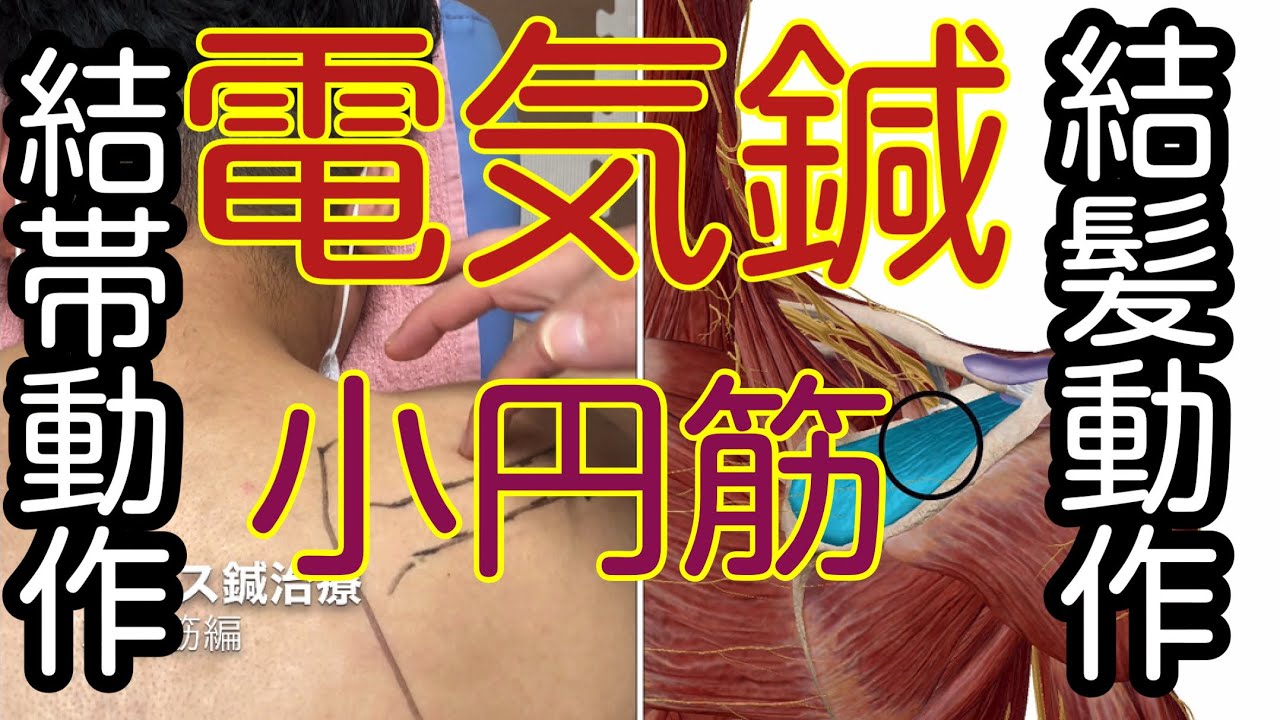 小円筋の電気（パルス鍼）鍼治療、五十肩、肩関節障害、結帯動作
