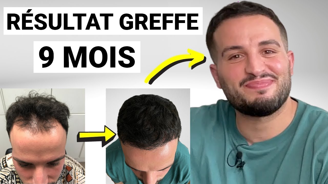 Greffe de cheveux : Ce qui a changé dans la vie de Mohand - et comment la vôtre peut changer ☀️