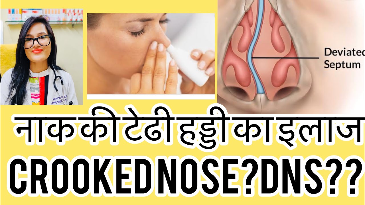 नाक कि टेढ़ीहड्डी का इलाज-Deviated-septum!crooked nose-homeopathy for Nasal Obstruction-Dr.Rukmani
