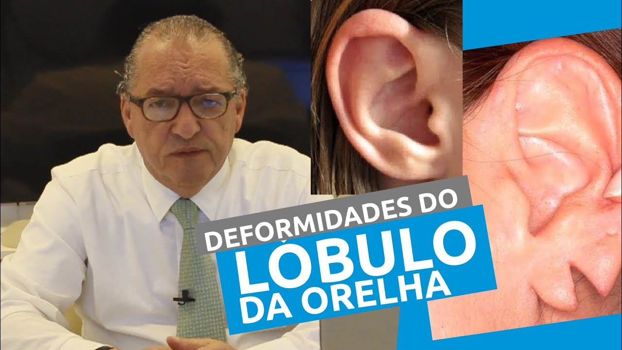 Cirurgia Plástica para Orelhas Deformadas . Dr Lecy Marcondes explica